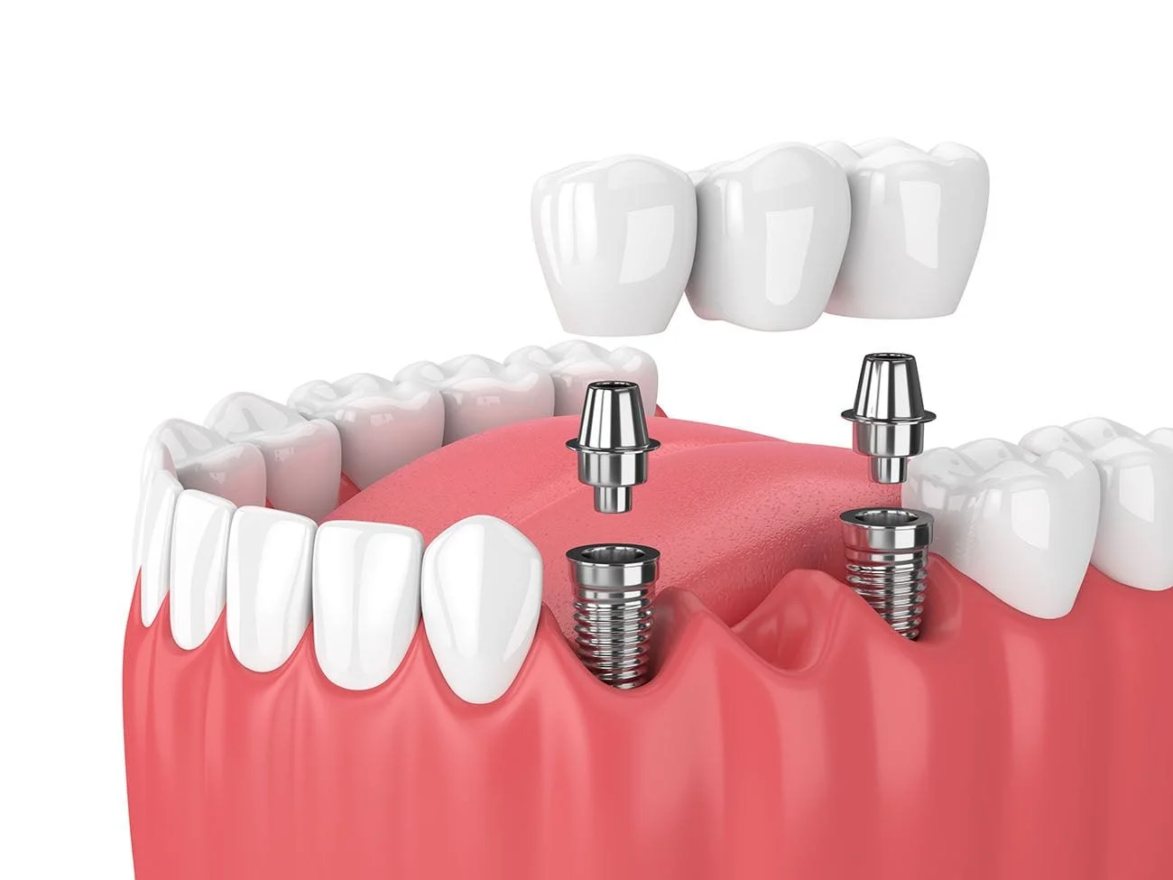 Implant-supported bridge dental