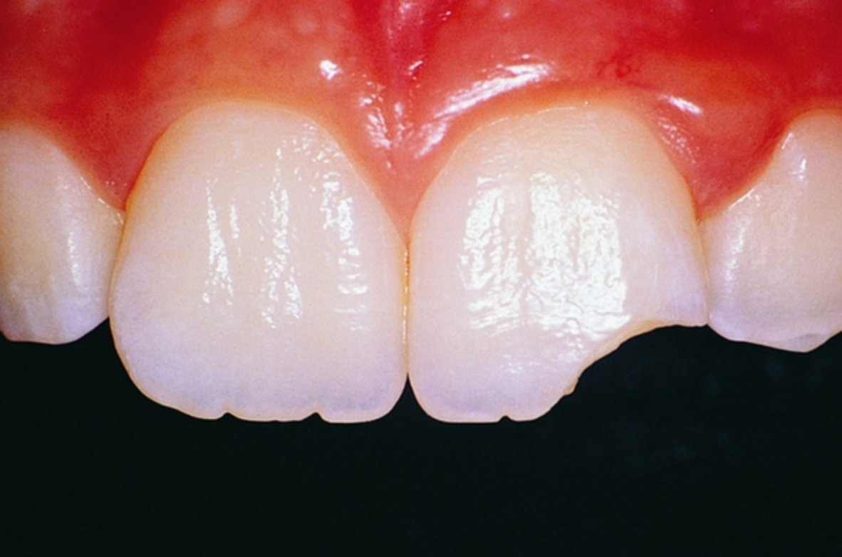 Dental trauma children treatment
