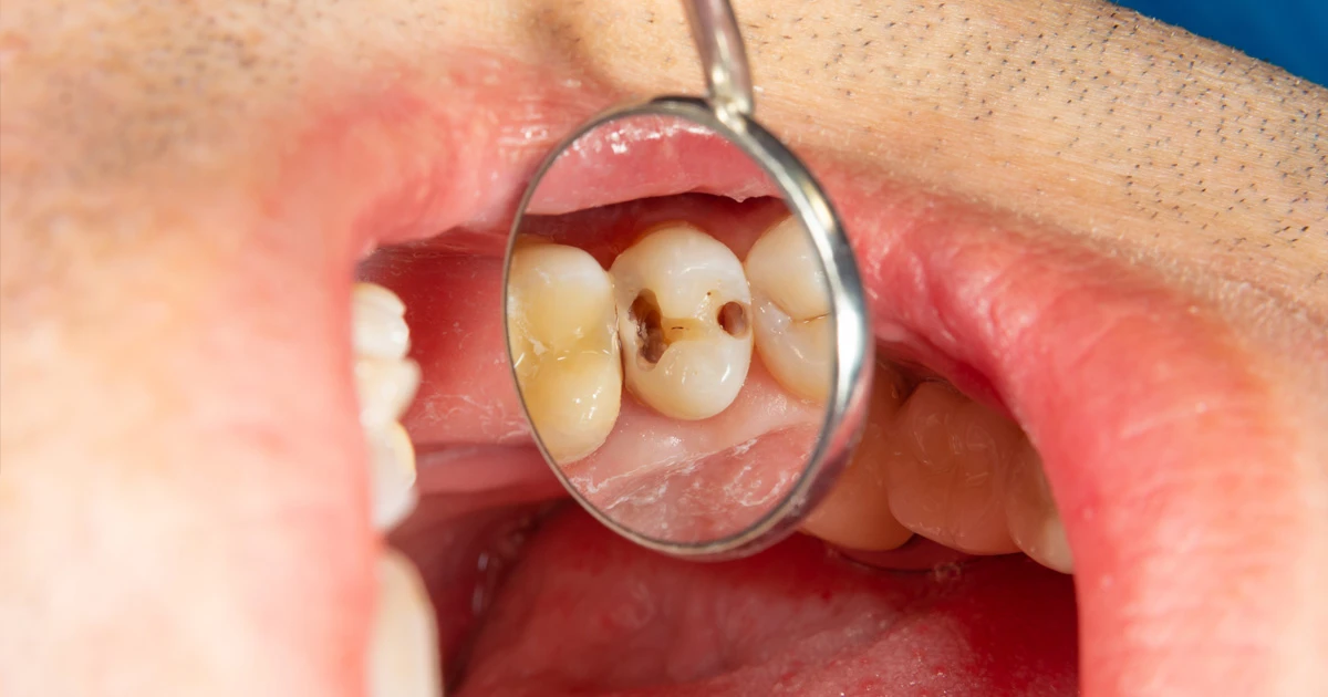 Dentine decay cavity treatment