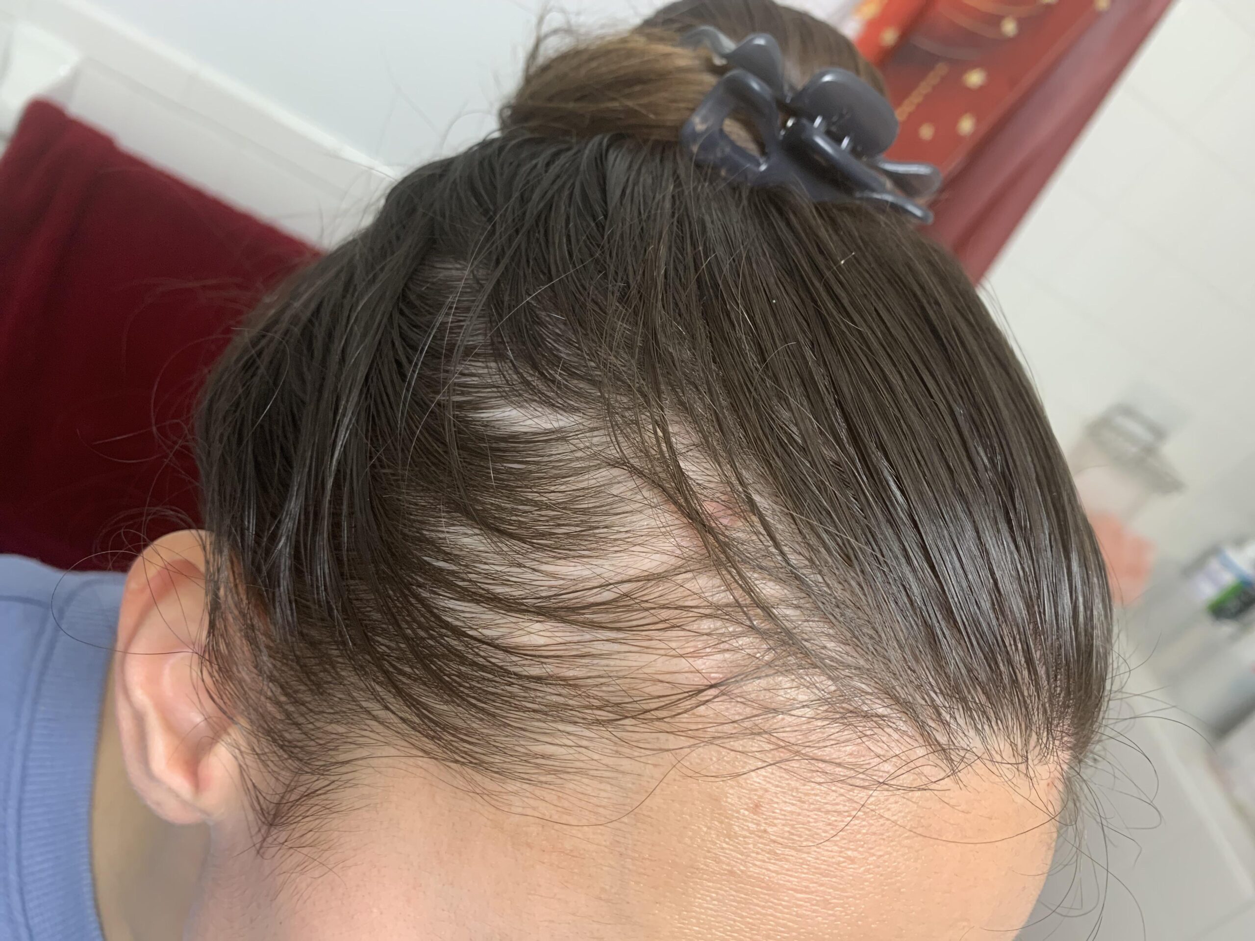 Diffuse alopecia areata widespread thinning