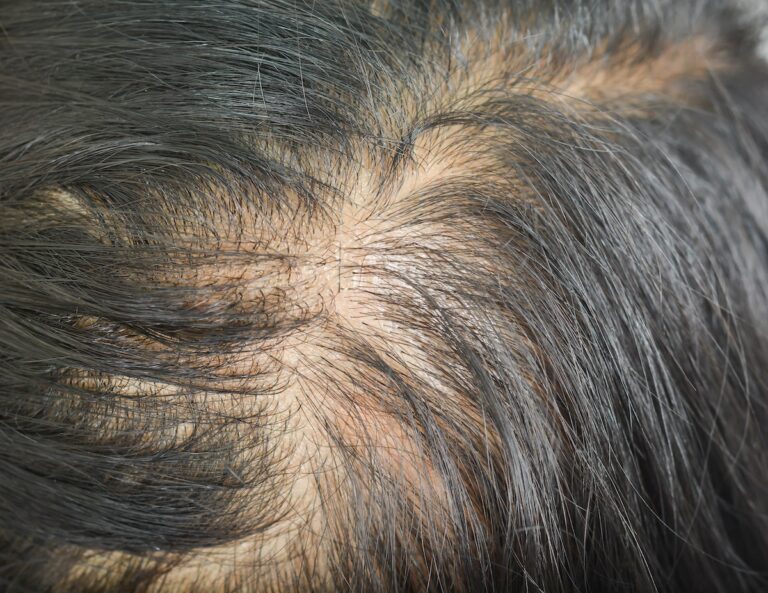 Diffuse hair thinning treatment for men and women