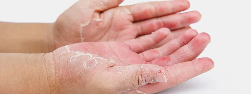 Dyshidrotic Eczema — Eczema