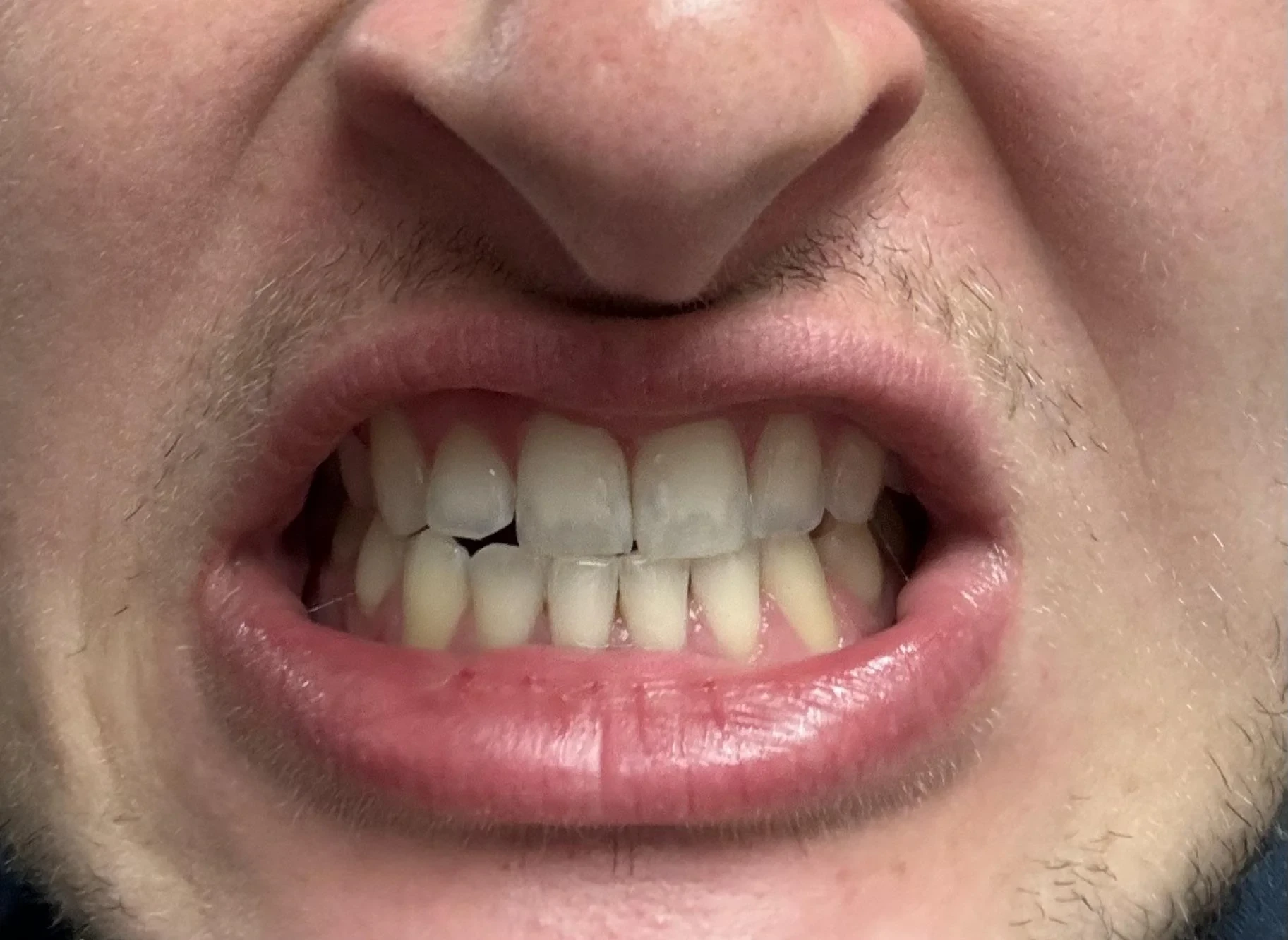 Enamel decay early cavity