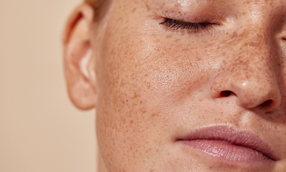 Genetic pigmentation predisposition
