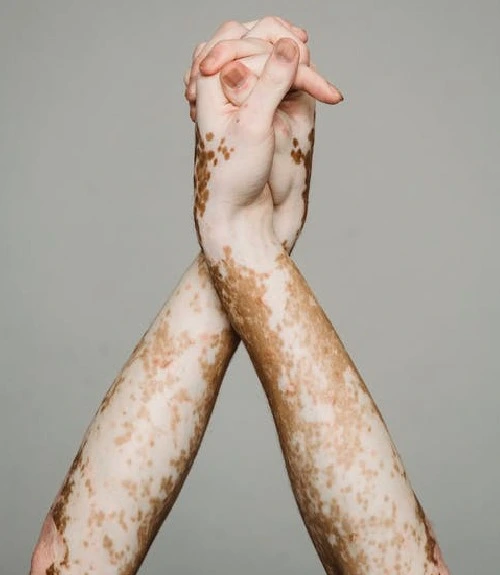 Expert Vitiligo Consultation — Vitiligo at Aliva Aesthetics