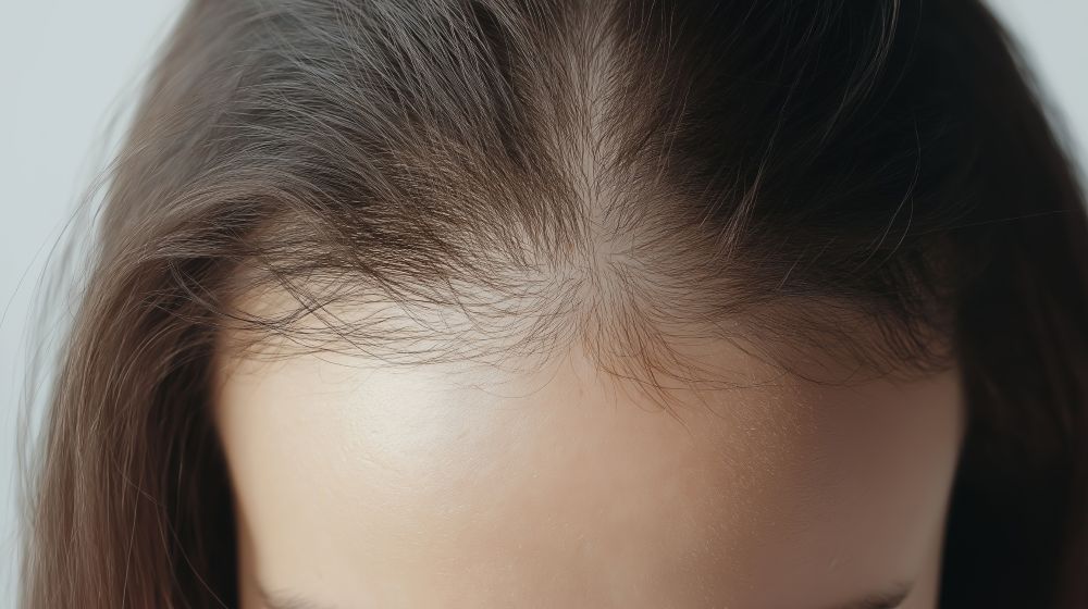 Female pattern thinning GFC treatment
