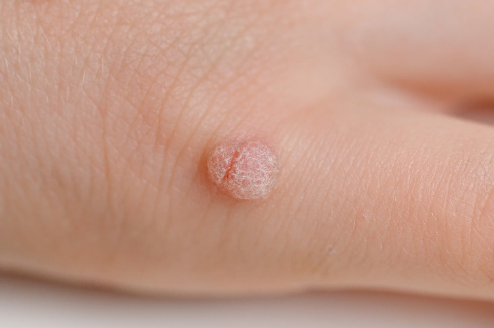 Filiform Warts — Skin Tags & Warts