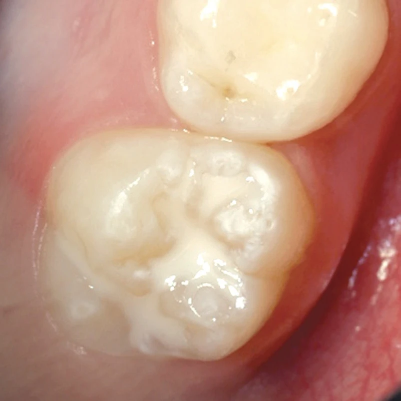 Fissure sealants prevention filling