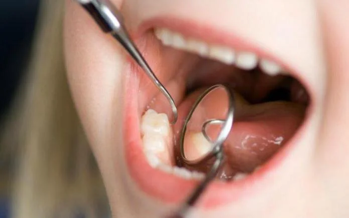 Fissure sealing kids teeth