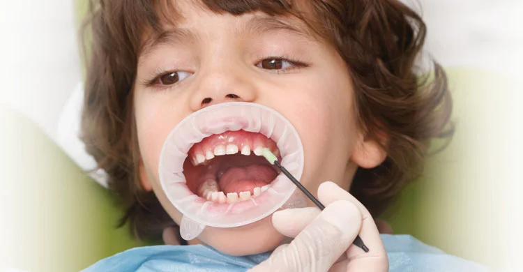 Fluoride application kids dentistry