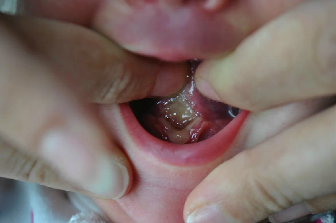 Understanding Frenectomy