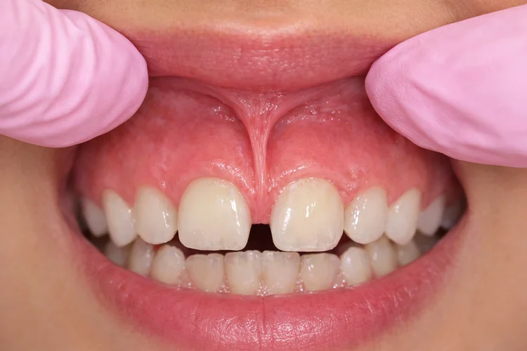 Frenectomy functional assessment