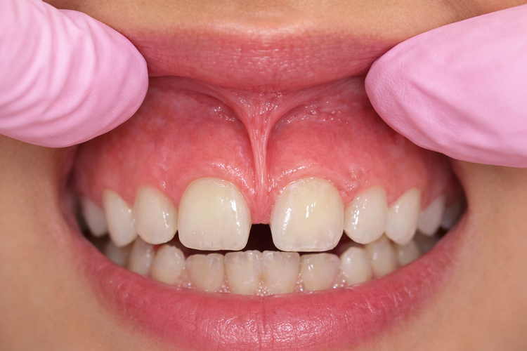 Frenectomy