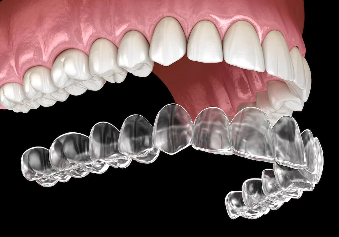 Full alignment clear aligner course