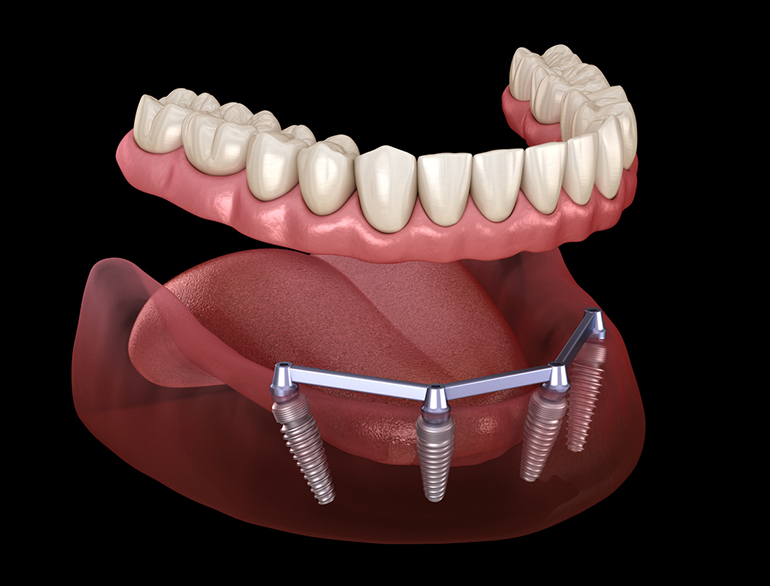Full Mouth Dental Implants