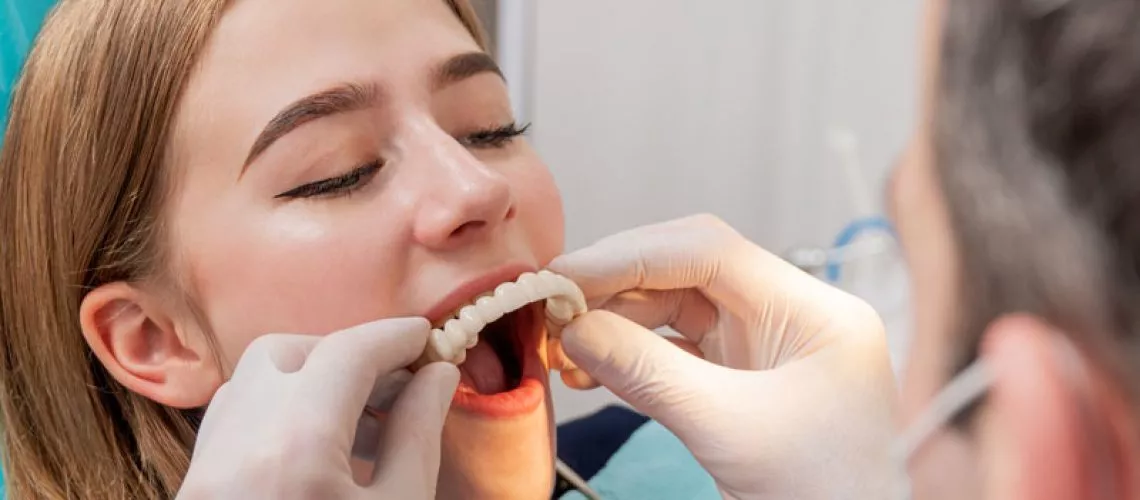 Understanding Full Mouth Dental Implants