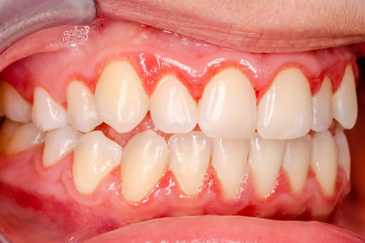 Gingivitis gum inflammation treatment