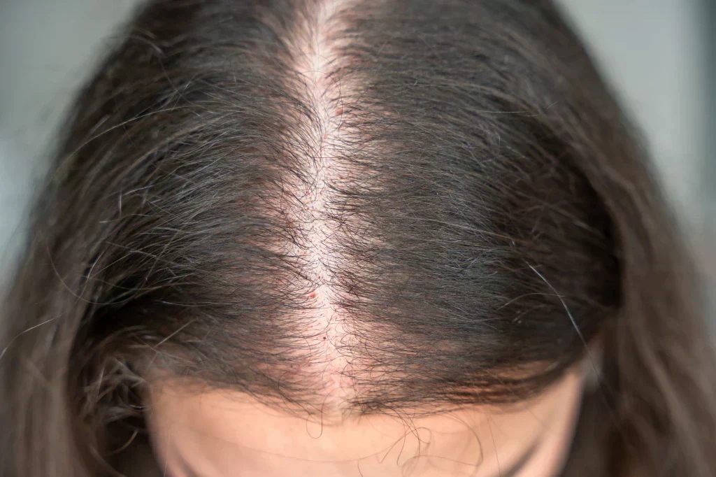 Gradual overall scalp thinning