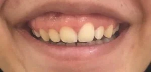 Gummy smile laser correction