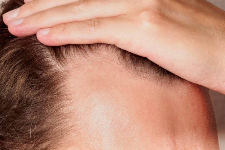 Hairline reconstruction hair transplant design