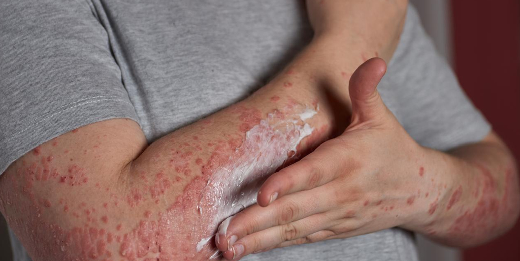 Heat Rash (Miliaria) — Skin Allergies & Rashes
