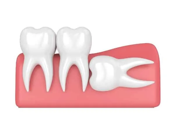 Horizontal impaction wisdom tooth