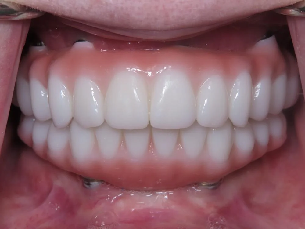 Hybrid denture implant supported
