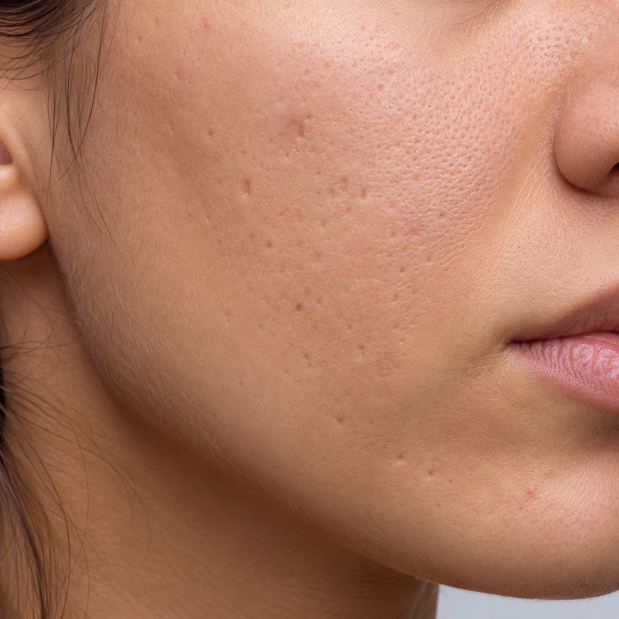 Ice pick acne scars on skin
