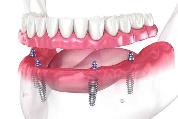 Implant supported dentures