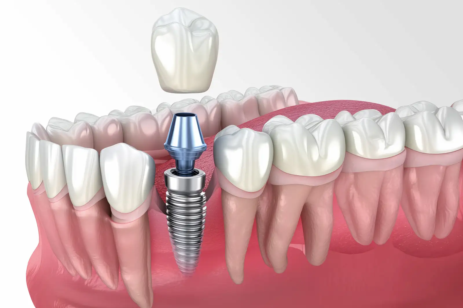 Implant crown placement dental