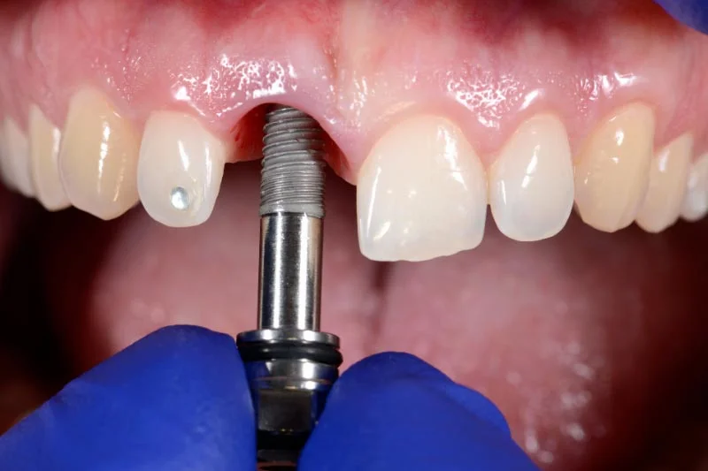 Dental implant placement surgery