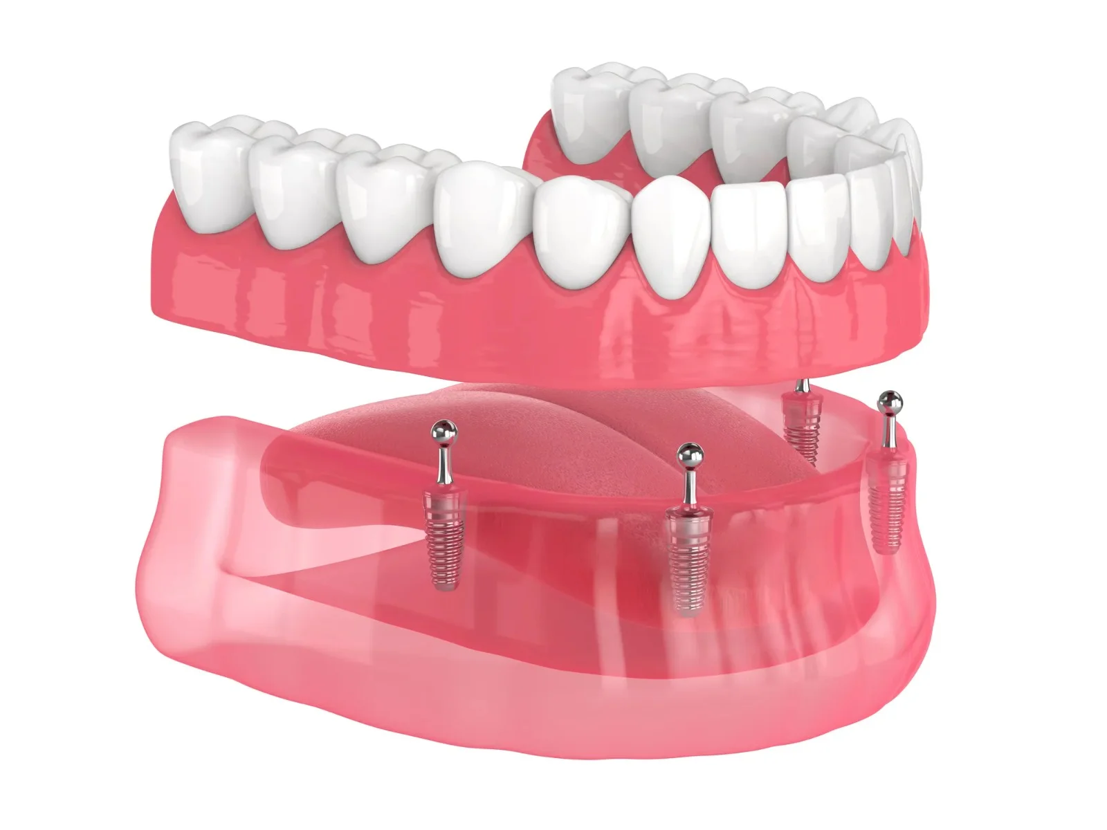 Implant supported overdentures