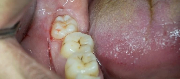 Infected wisdom tooth emergency