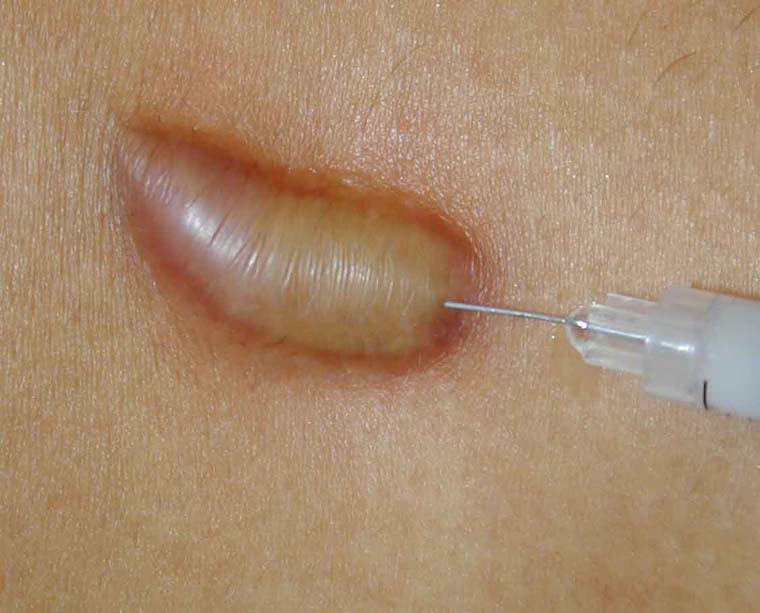 Intralesional steroid injection scalp alopecia