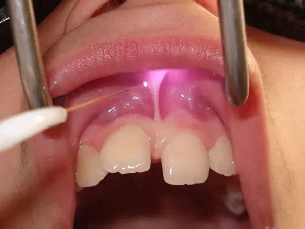 Laser frenectomy treatment