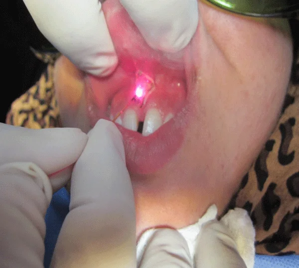 Laser frenectomy procedure