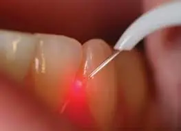 Dental laser gum treatment