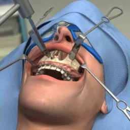 Le Fort osteotomy jaw surgery