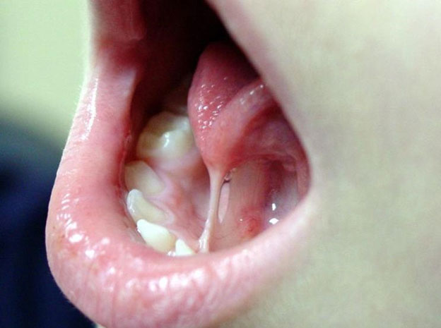 Frenectomy