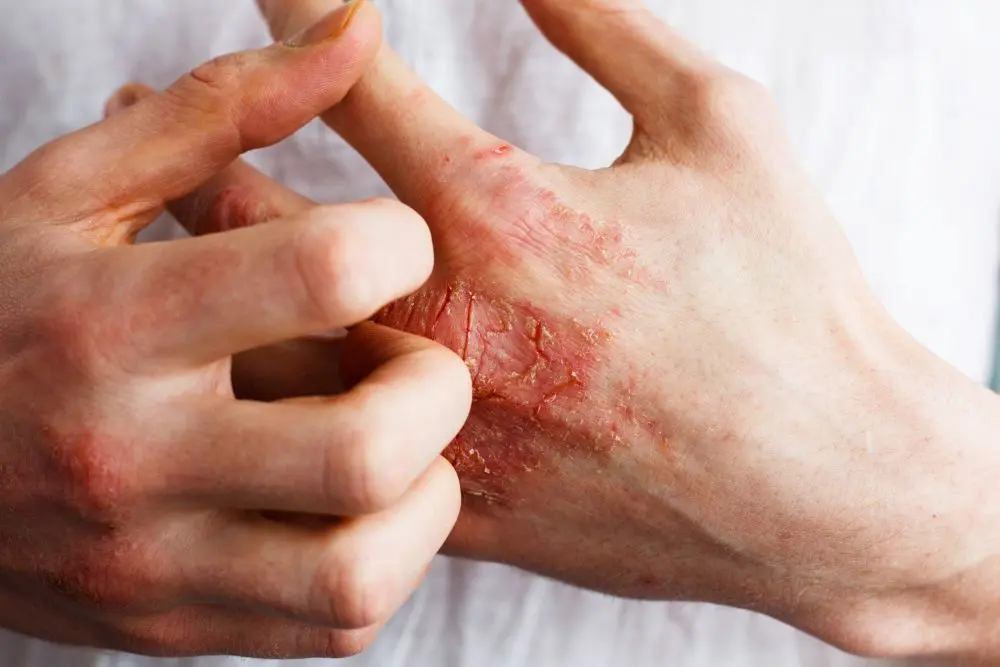 Long-Term Maintenance Plan — Eczema at Aliva Aesthetics