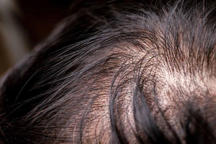 Mid-scalp density hair transplant