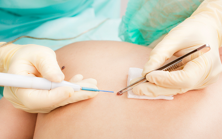 Suspicious mole assessment dermoscopy