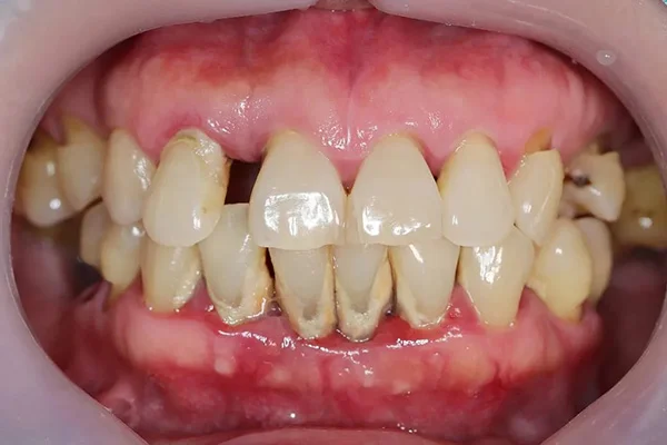 Moderate periodontitis bone loss