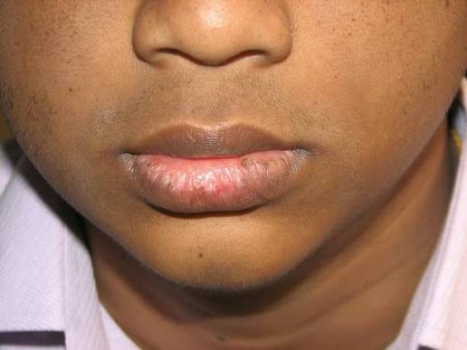 Mucosal Vitiligo — Vitiligo