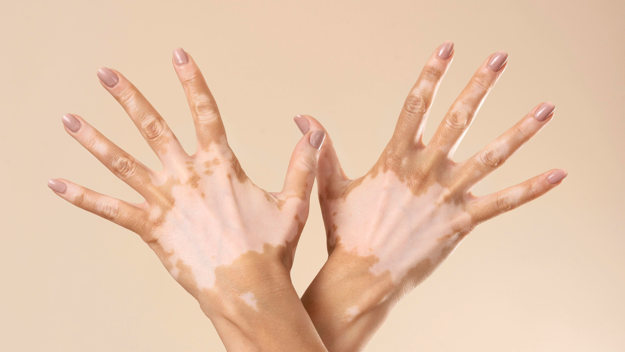 Non-Segmental Vitiligo — Vitiligo