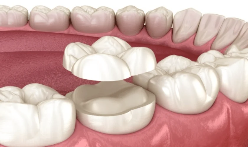 Onlay partial crown restoration
