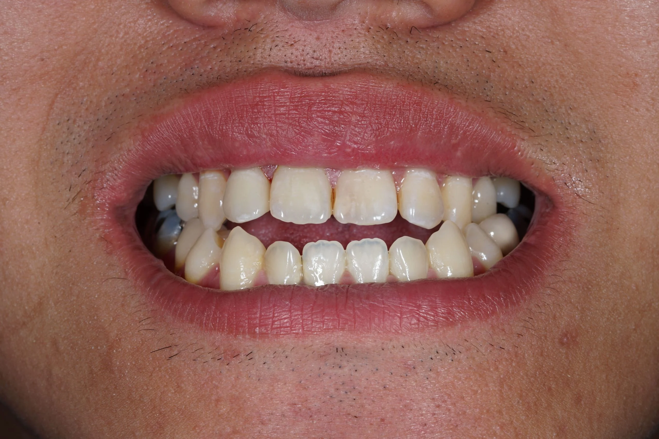 Open bite braces correction