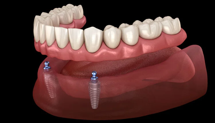 Overdentures