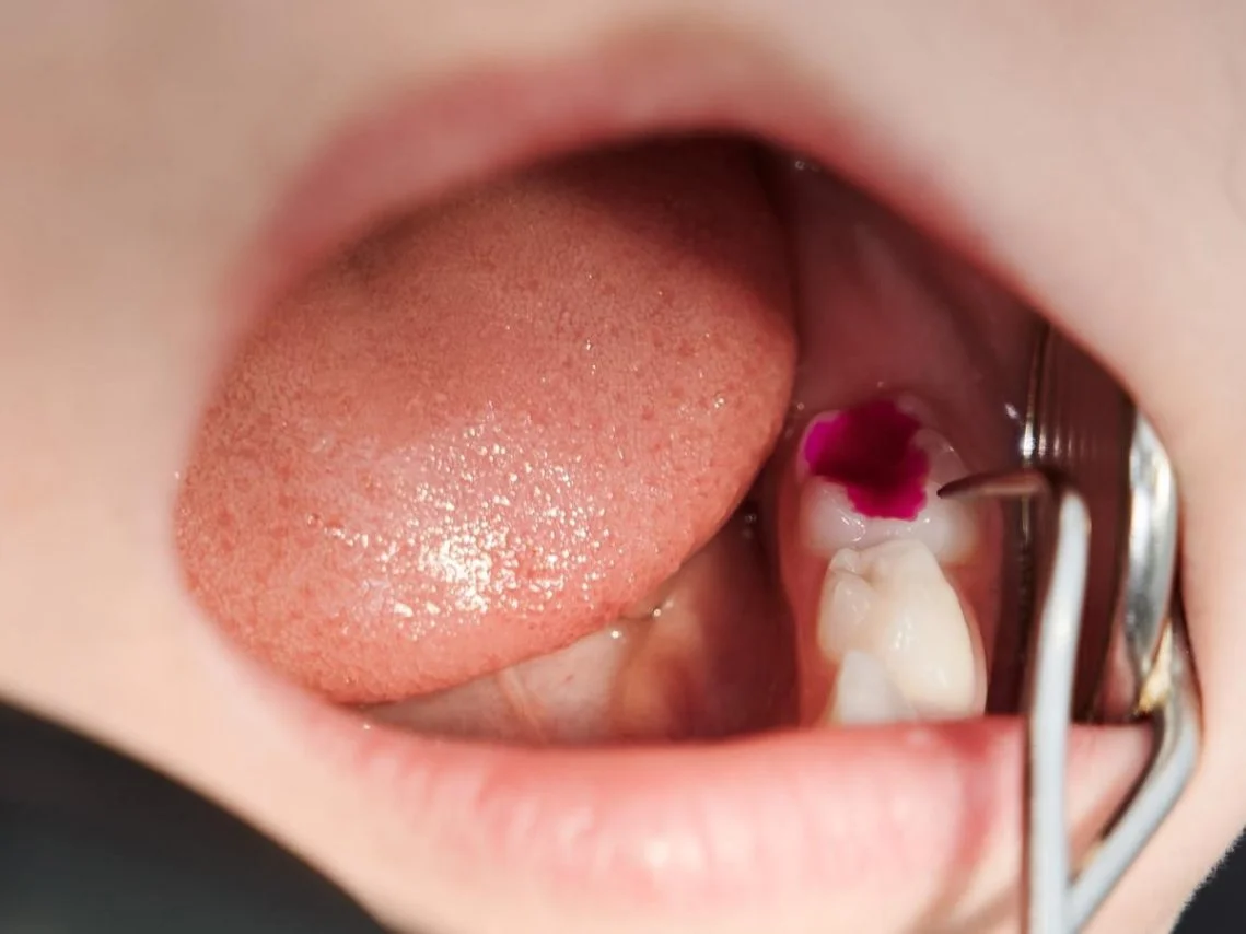 Painless filling children dental