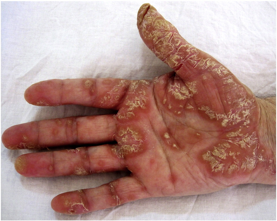 Palmoplantar Psoriasis — Psoriasis